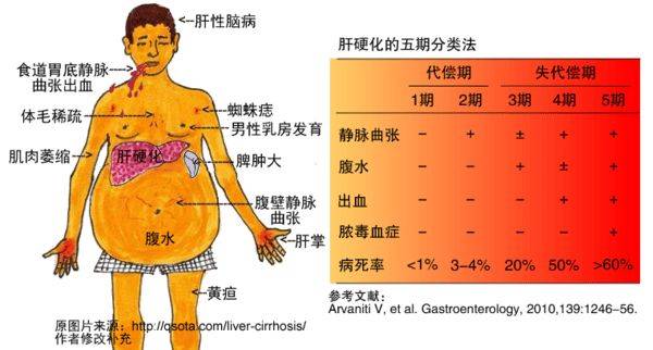 治疗肝硬化成功的标准有哪些