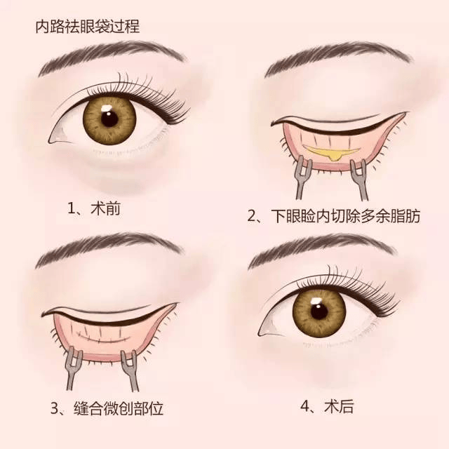 下眼睑