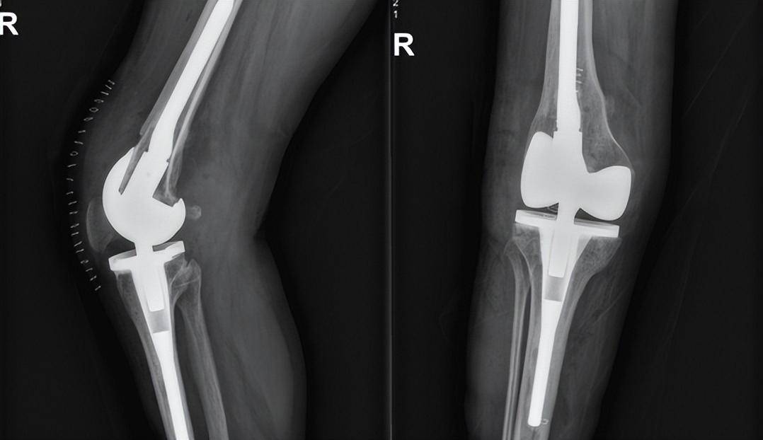 苏州高新人民医院关节外科成功为脊髓灰质炎患者进行膝关节置换