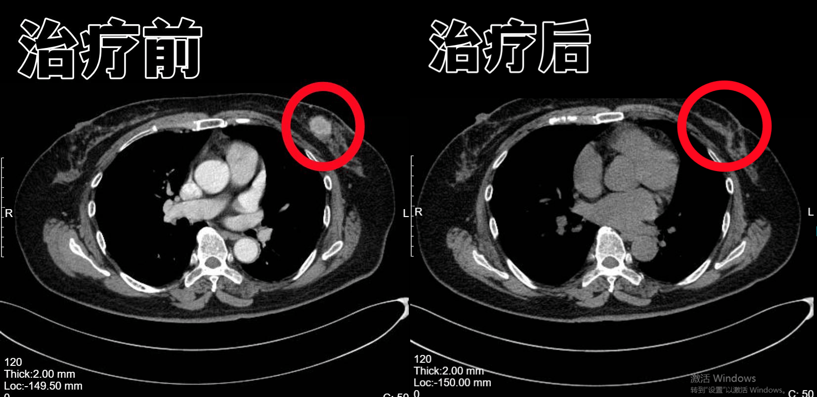 病例分享 ▏乳腺恶性肿瘤 如今肿瘤消失指标一切正常(图4)