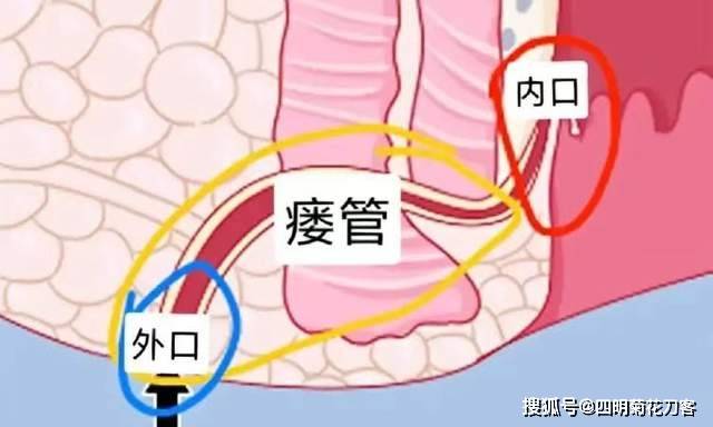宁波肛肠专家—彭联明谈：肛瘘为什么不能自愈？