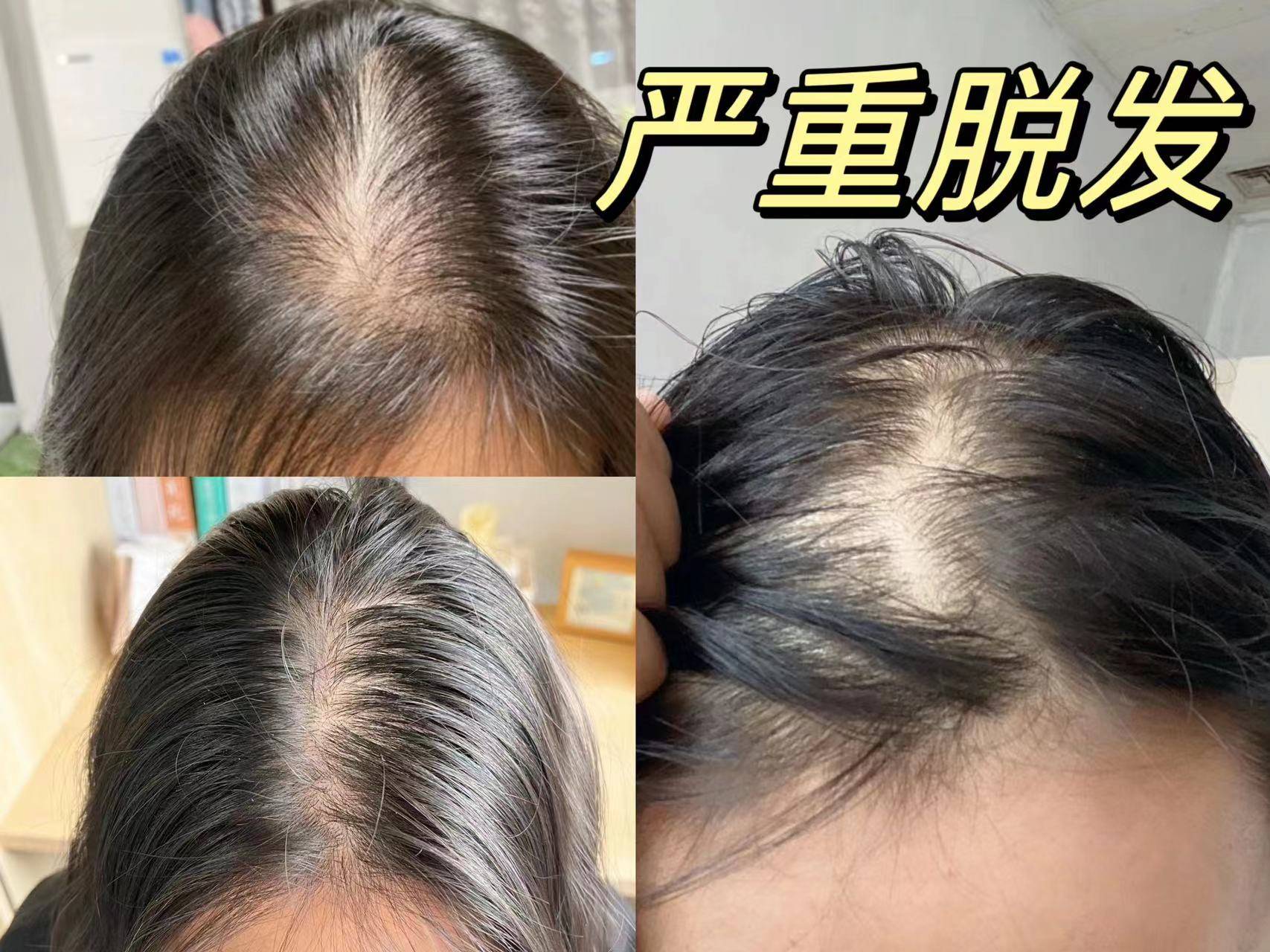 二十八岁头顶头发稀少，发缝宽，有什么好的方法解决？