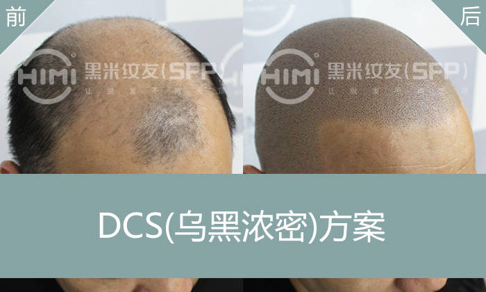 纹发和植发哪个效果好些？改变地中海秃顶形象，变帅气寸头