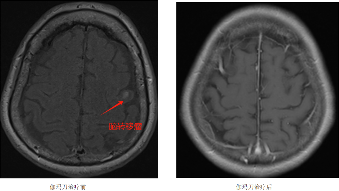 治疗脑瘤的神器｜伽玛刀治疗脑转移瘤(图1)