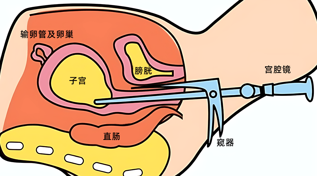 魅可蜜丨子宫内膜炎是怎么引起的？(图2)