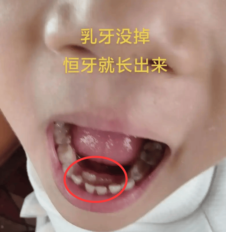 乳牙坏了不用管,换恒牙就没事了?牙科专家给出权威解释