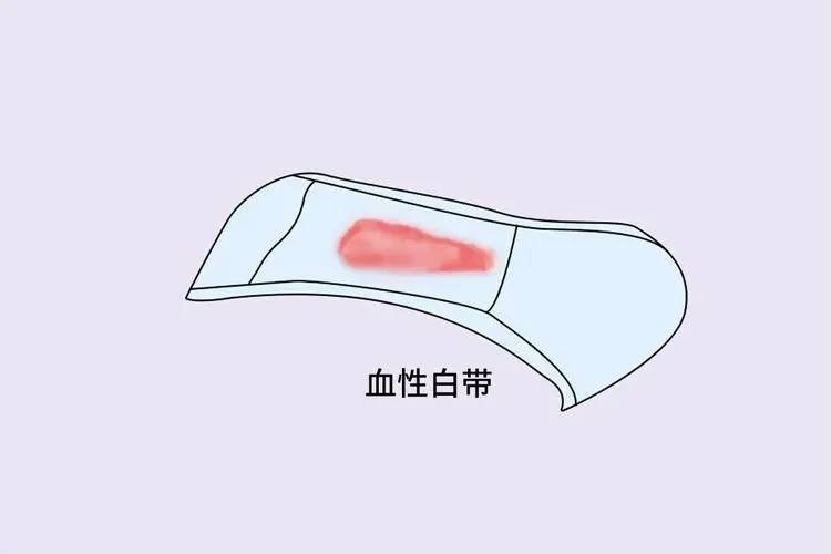 白带带血，到底出了什么问题？杭州新城妇科医院