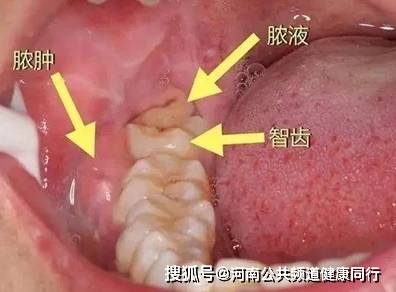 不容忽视的口腔问题：智齿冠周炎 | 郑州市口腔医院 张睿(图2)