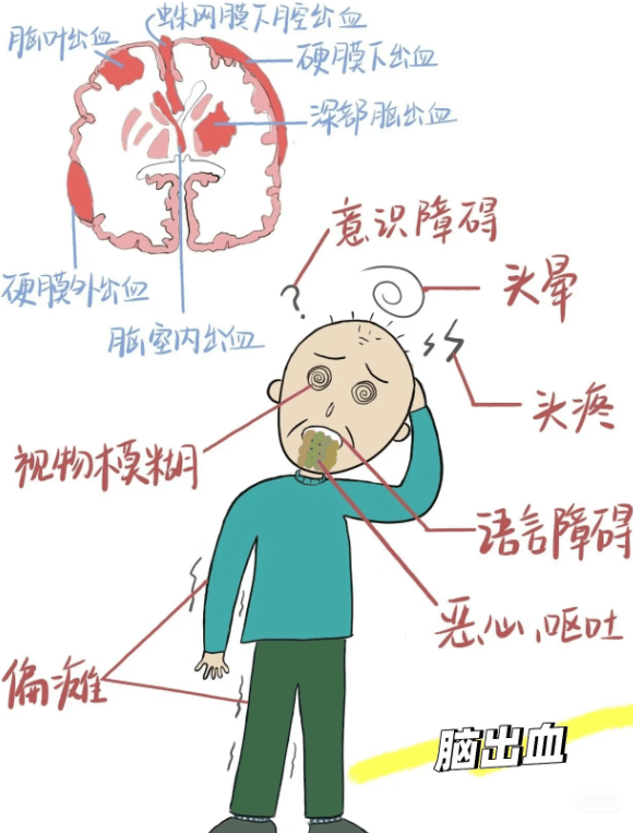 你了解什么是脑出血吗？