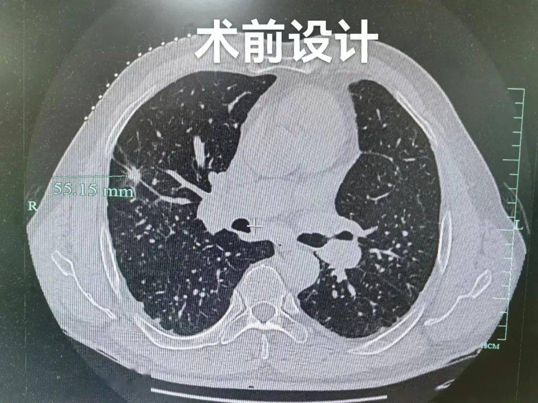 【医文医话】呼吸一科：肺下叶胸膜下小结节的活检策略