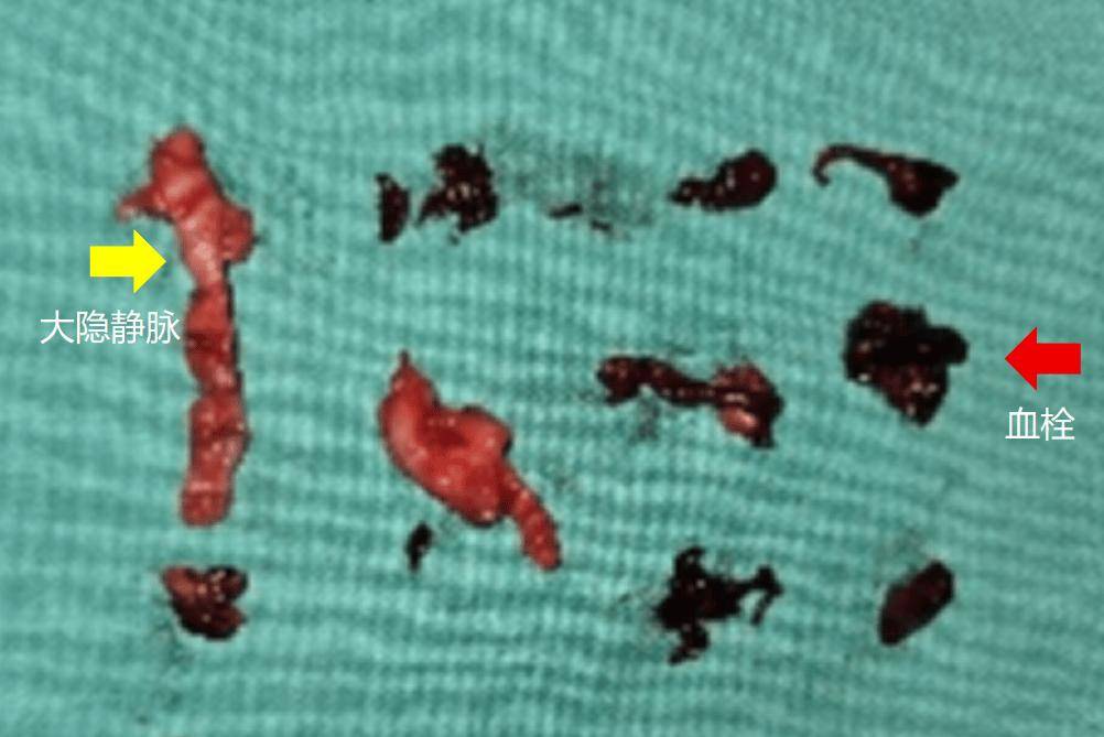 输液时抽出“虾线”状血条！？我还有救吗……