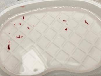输液时抽出“虾线”状血条！？我还有救吗……