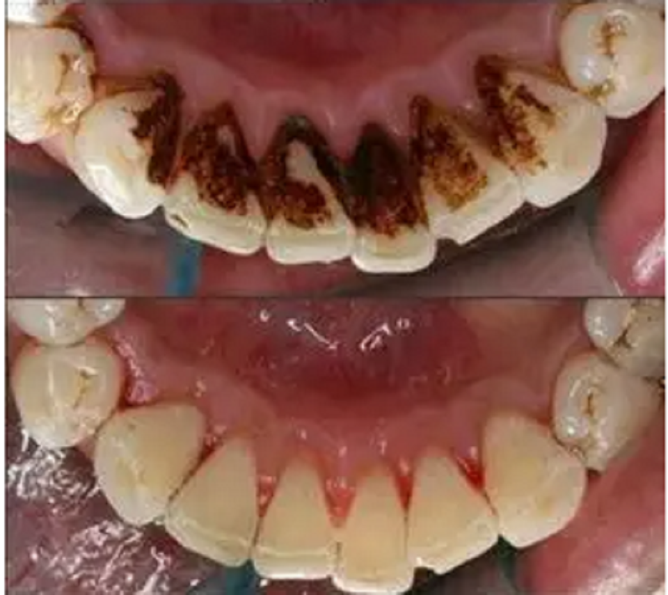 长期抽烟,牙齿又黑又臭?快试试这个法子,烟渍臭味几天就没了!