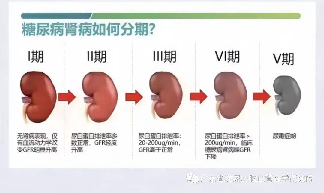 糖尿病最常见,最严重的并发症之——糖尿病肾病