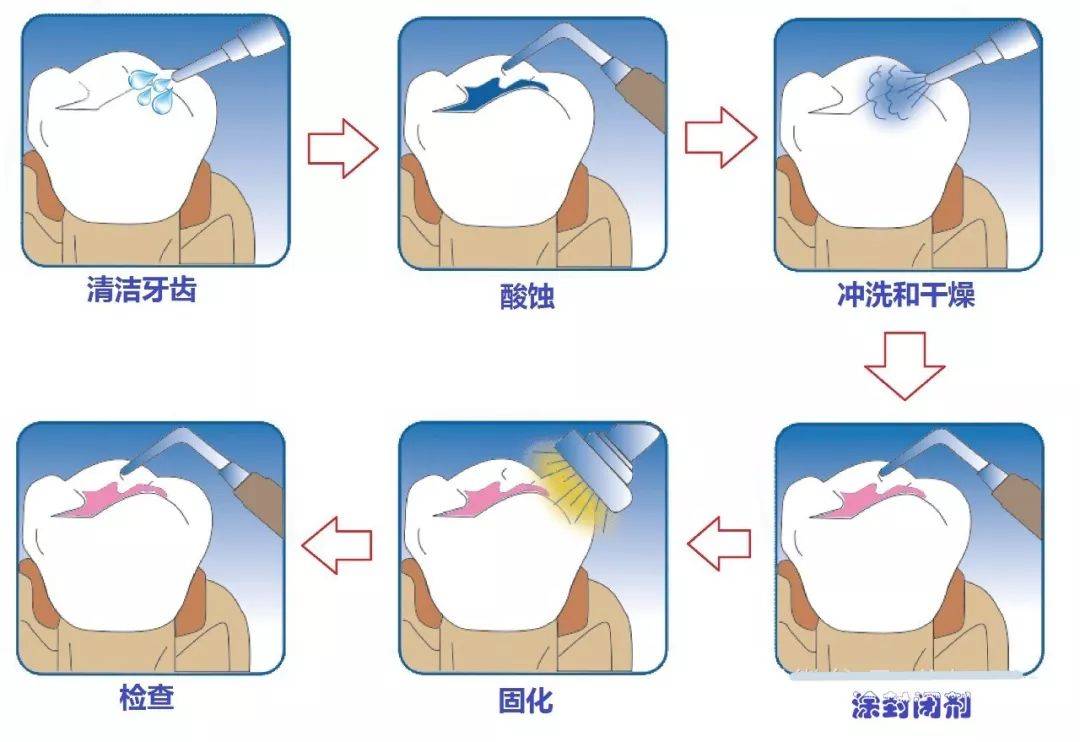 第二恆磨牙一般在12歲左右萌出後進行窩溝封閉.幾歲做窩溝封閉合適?