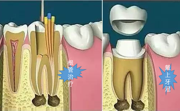 經過根管治療牙齒不如自然牙堅固,可能因為正常的咀嚼而出現牙齒隱裂