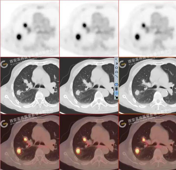 多发肺结节病例:重症感染 | 惠普尔养障体肺炎