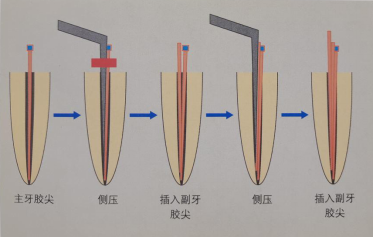 根管中的"冷牙胶"和"热牙胶"是什么?你能分清吗?