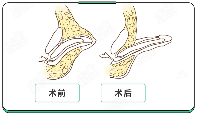 男婴小鸡鸡应该多长才正常？