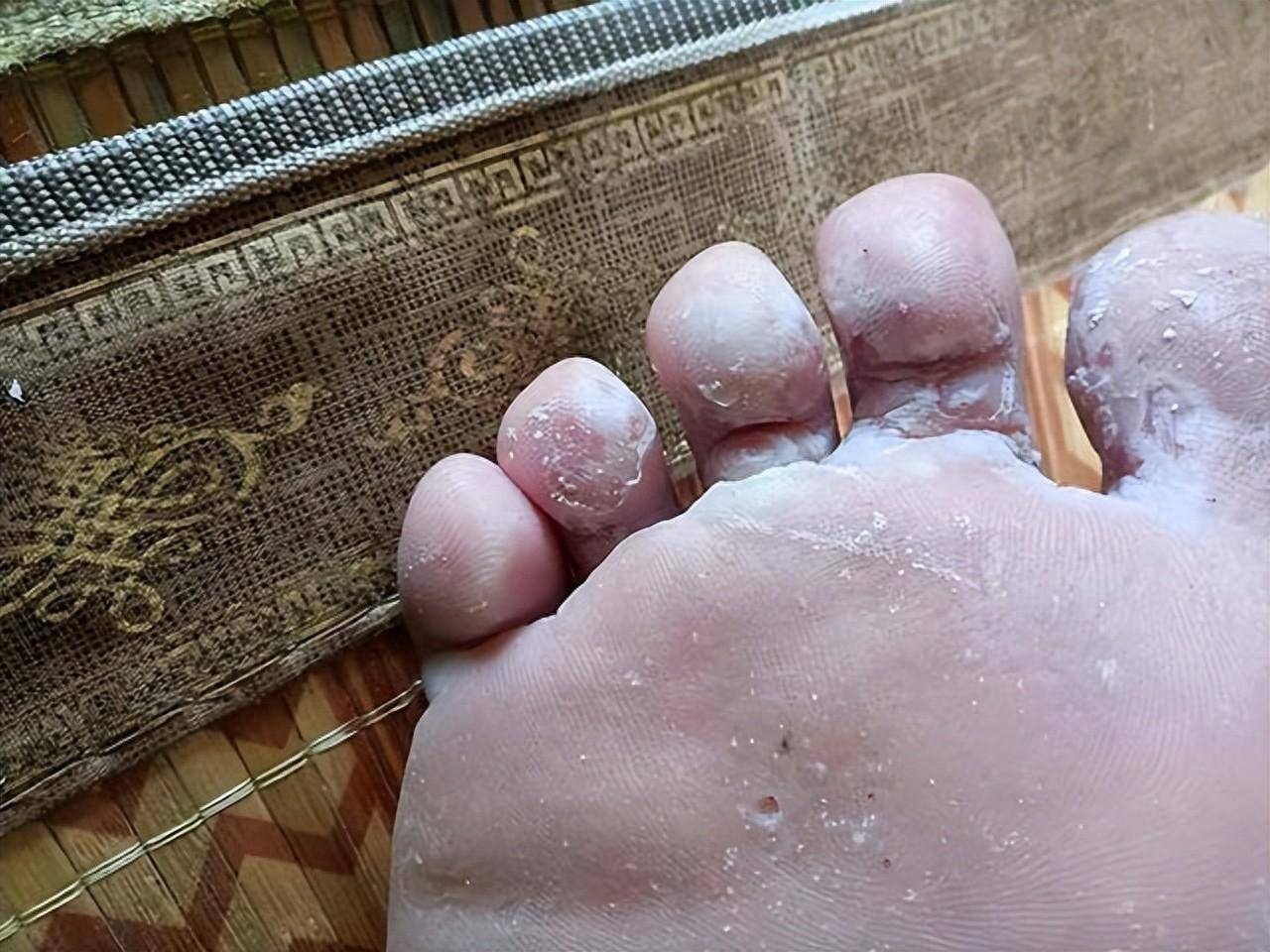 每年夏天就开始脚底严重掉皮,长水泡,不小心扣烂就又开始开裂溃烂流水