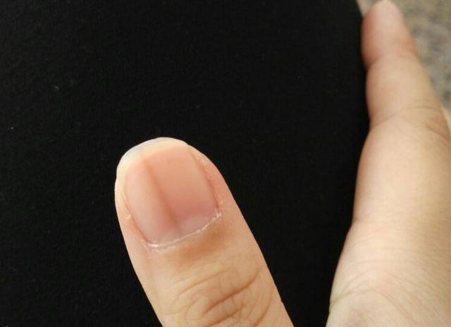 修改指甲若出现4种反常,或是这几种问题的信号假设指甲上出现黑色竖纹