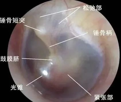 2外耳道異物:3耵聹栓塞:4急性中耳炎:5分泌性中耳炎:6慢性化膿性中耳