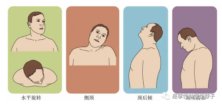 痙攣性斜頸加重時會亮起這六個