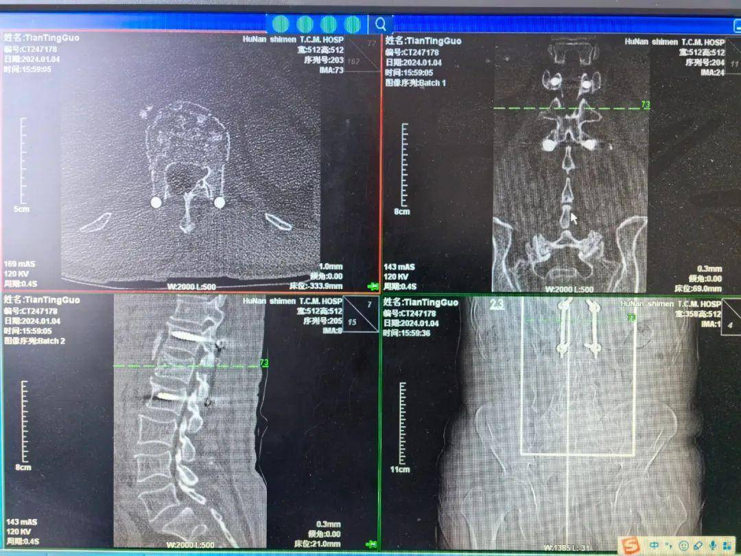 脊柱骨折护理常规图片
