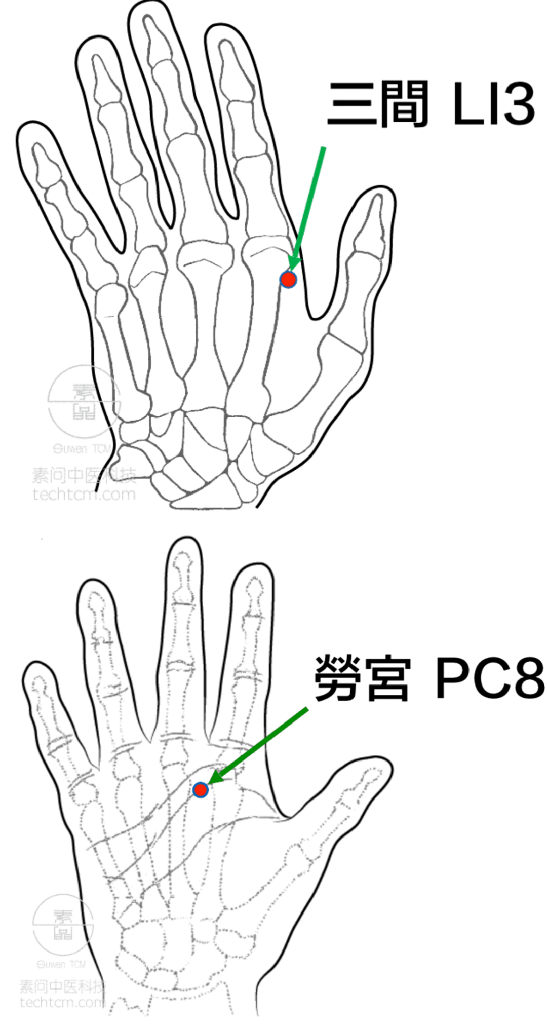 倪海廈的經典透穴組合,對於病程嚴重者,應用三間透合谷,液門透中渚