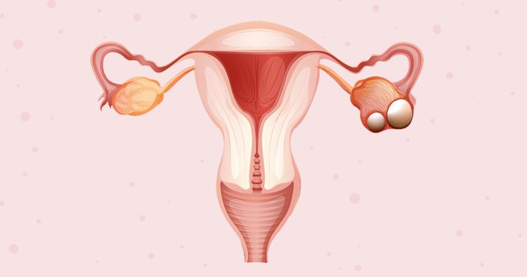 卵巢囊肿会导致不孕吗？