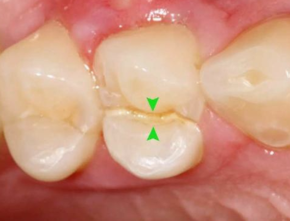 這已經是現代口腔醫學中的一個基本原則牙醫都推薦根管治療以後要做