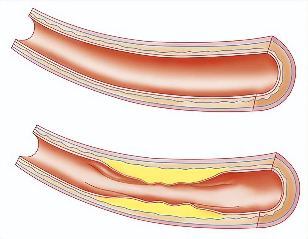 颈动脉狭窄怎么形成的?要如何治疗?详细了解它的"前世今生"