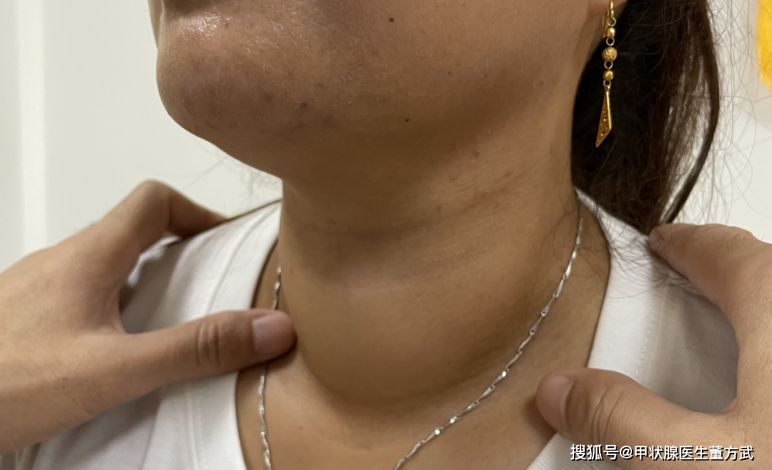 25岁女生拖成癌症:甲状腺结节离癌有多远?