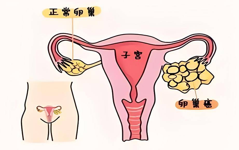 女性腰围变粗未必是发福 或许这一癌症你得注意了