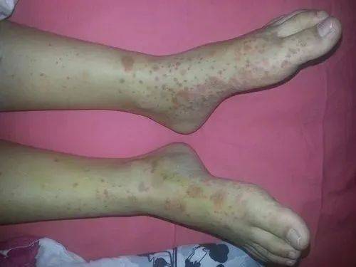 硬皮病能引发哪些炎症?_患者_病人_关节炎