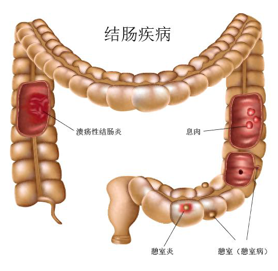 结肠炎位置图图片