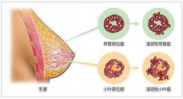 乳腺结节会发展成乳腺癌吗?