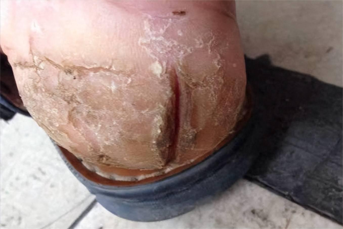 三招搞定脚后跟干裂!这个方法比涂100遍身体乳还有效!_皮肤_效果_养护