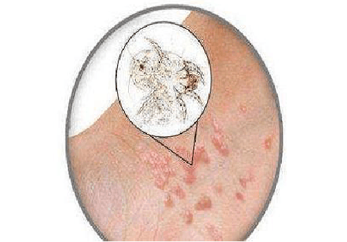 长沙皮肤病医院解答疥疮有哪些明显症状?