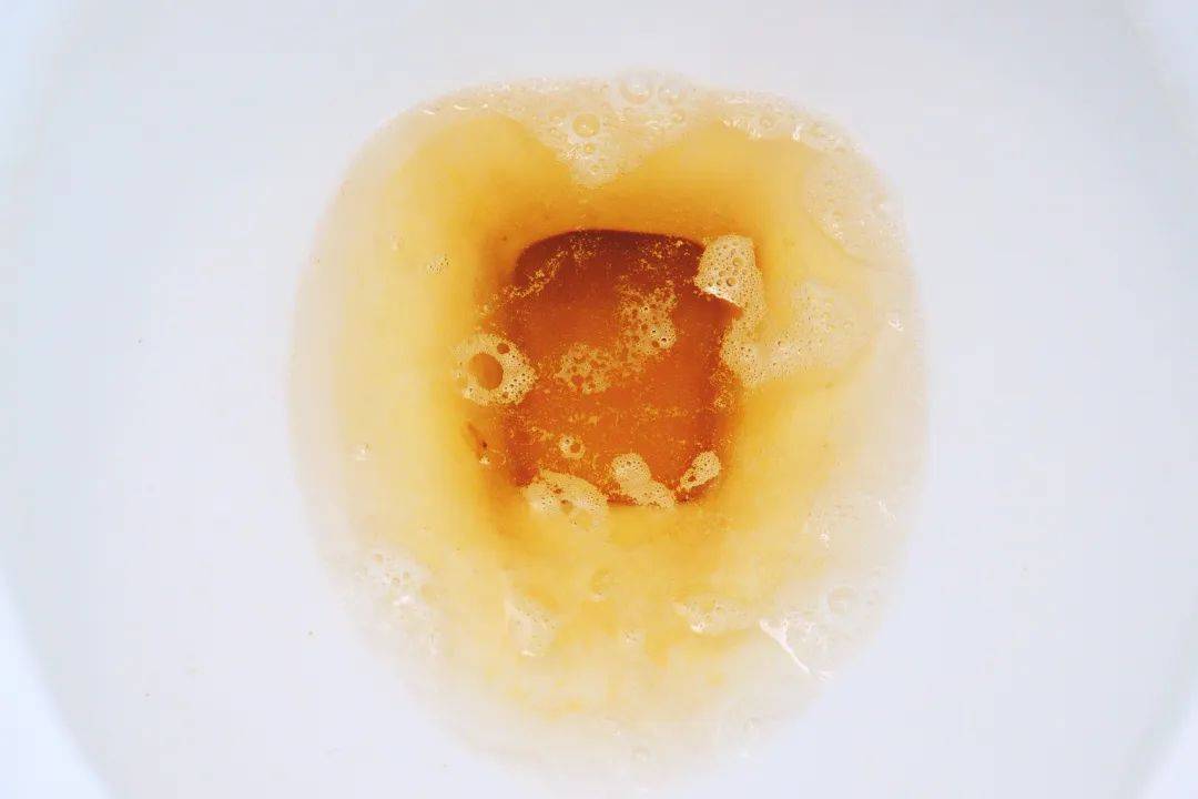乳糜尿分层图片图片
