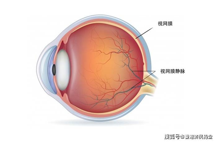 用于治疗新生血管性(湿性)年龄相关性黄斑变性和糖尿病性黄斑水肿患者