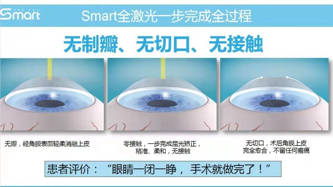 smart全激光手术是一种创新的表层角膜屈光手术方式,是tprk全激光手术