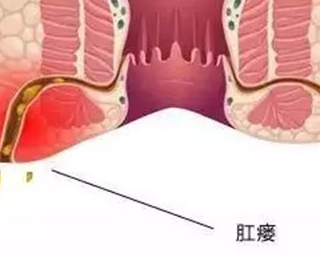 肛瘘是痔疮吗?两者有什么关系?怎么区别?