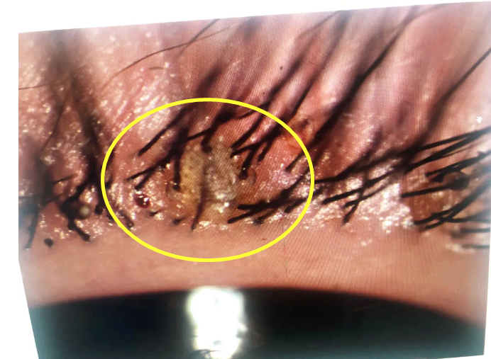 医生紧急提醒_睫毛_眼睛_胶水