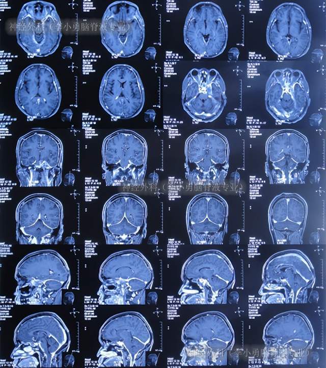 文章 颅内外沟通瘤术后脑积水颅内真菌感染肉芽肿意识障碍重