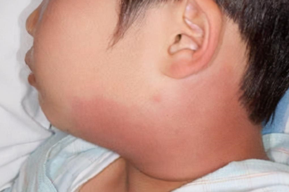 被猫抓之后就会患"猫抓病"?医生:事实哪有那么简单_时候_淋巴结_患者