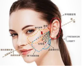 惊:拉皮手术的风险和后遗症,拉皮手术的后遗症太厉害