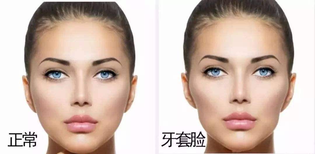 拒绝正畸后遗症——牙齿松动,牙龈黑三角,牙套脸