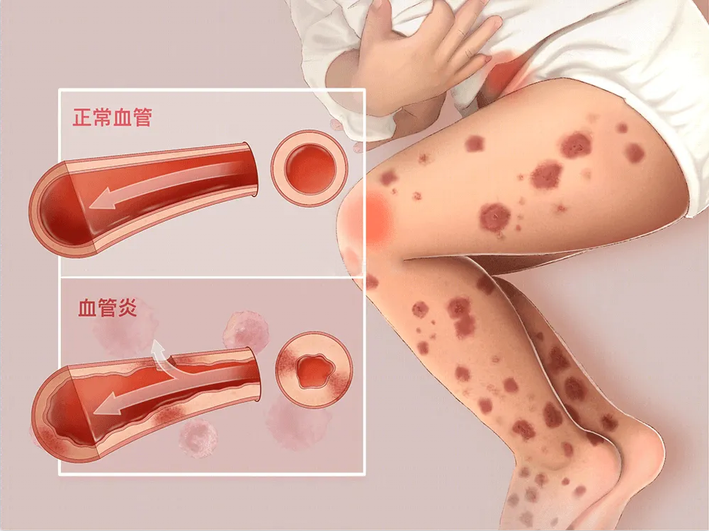 过敏性紫癜越治越严重?问题出在哪?_治疗_患者_症状