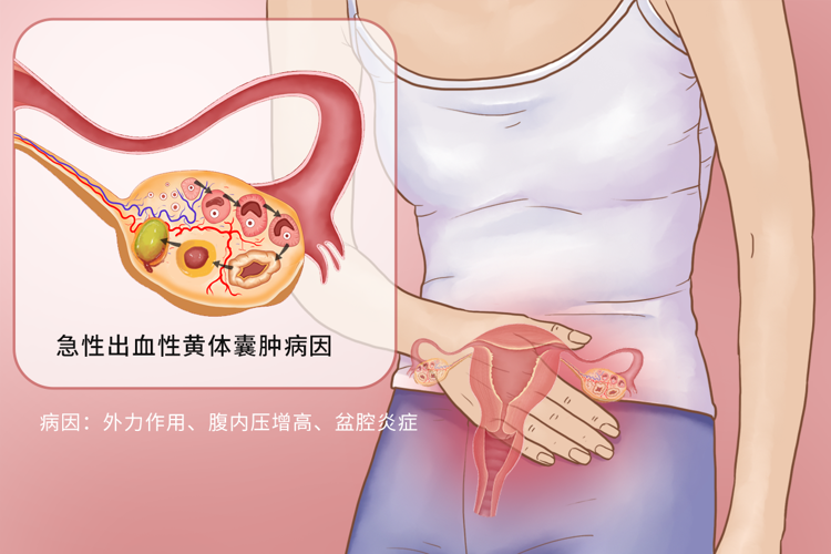卵巢囊肿(包括黄体)因剧烈运动可能会出现扭转,破裂,从而诱发妇科